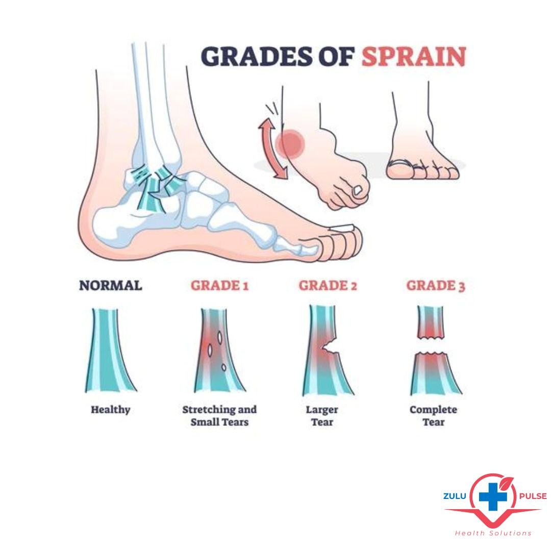 ankle sprain grades