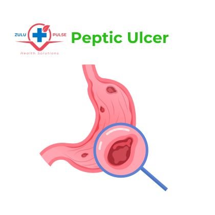 peptic ulcer disease