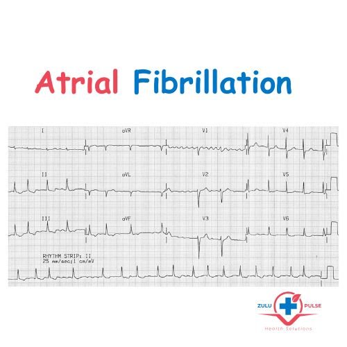 ECG showing Atrial Fibrillation (AF)