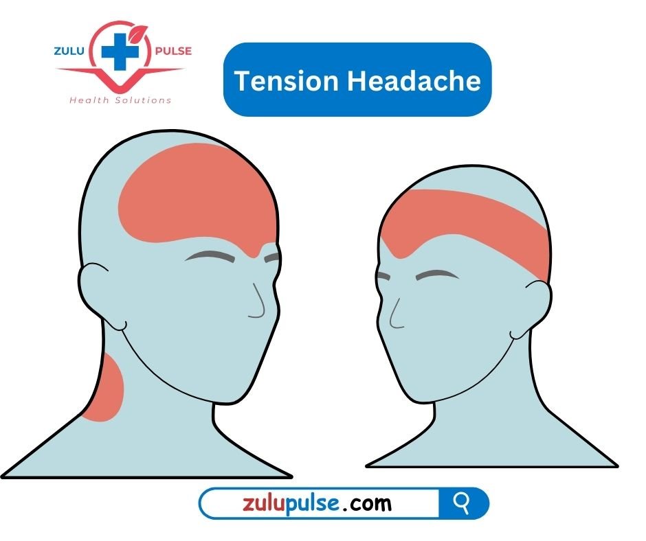 Tension headache pattern 